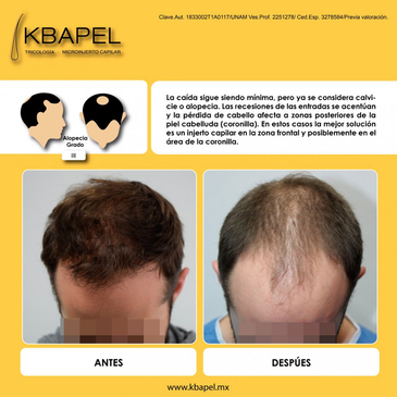 Slider image (5) Kbapel Hair Transplant